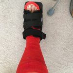 My leg in a cast